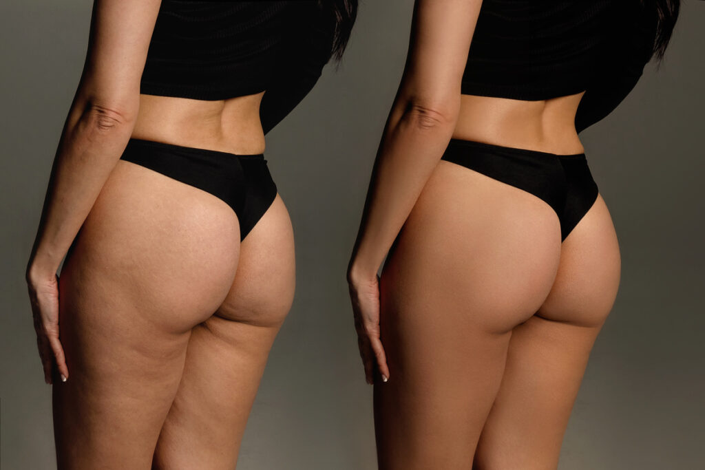 modelage des fesses à Montpellier