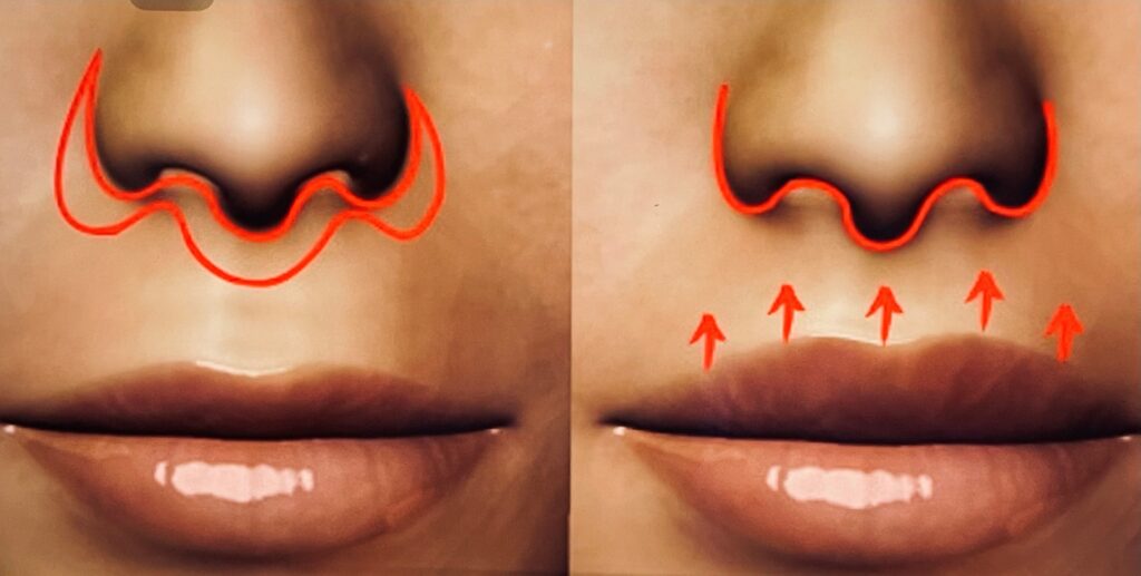 Qu'est-ce que le lifting de la lèvre supérieure ou lift lip ?